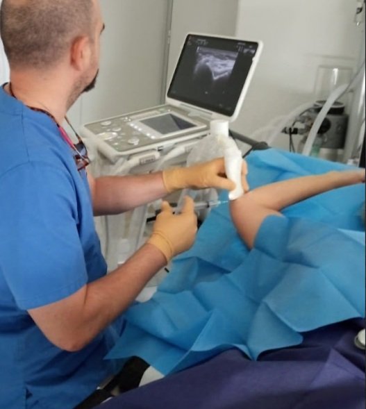 Infiltración ecoguiada del nervio cubital en Madrid-Dr Bellon- Unidad del dolor