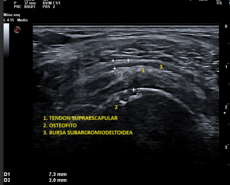 Ecografía musculoesquelética de hombro con inflamación – Dr. Bellón, Madrid